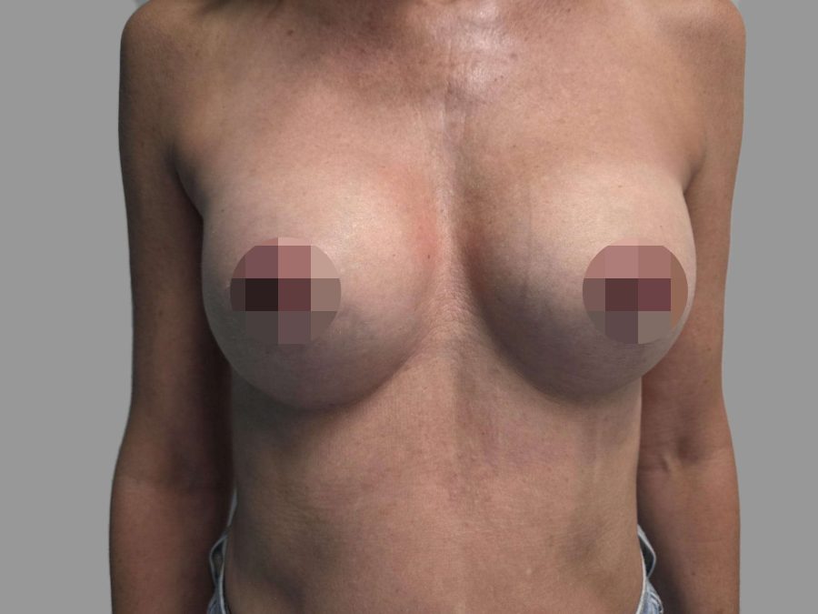 Breast Augmentation (Enlargement) - After