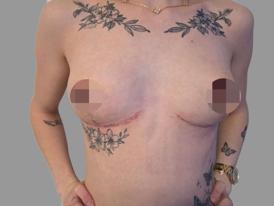Breast Augmentation (Enlargement) - After