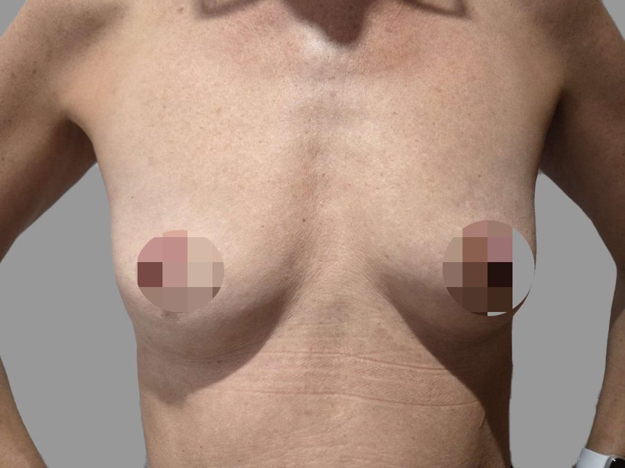 Breast Augmentation (Enlargement) - Before