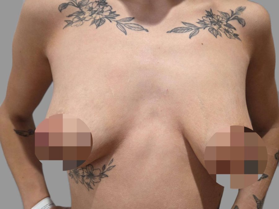 Breast Augmentation (Enlargement) - Before