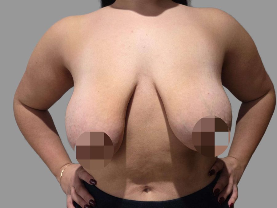 Breast Lift - Before