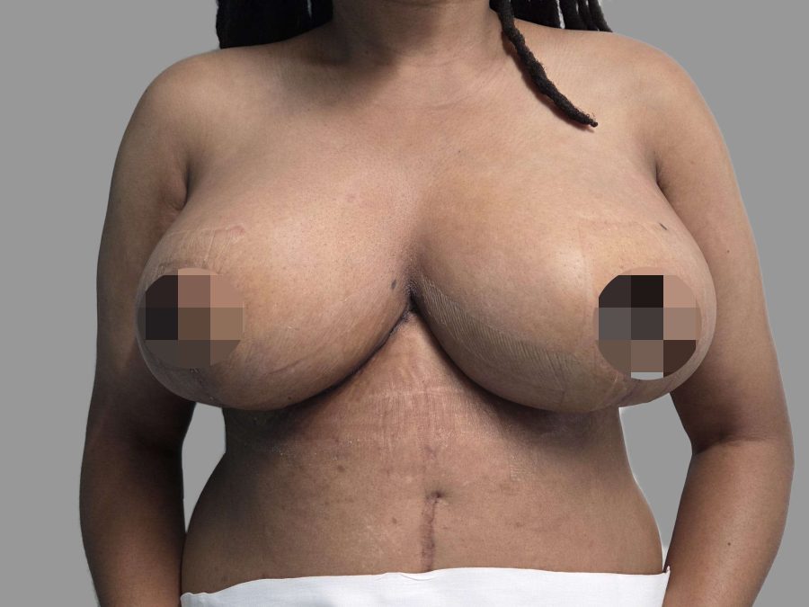 Breast Reduction - After