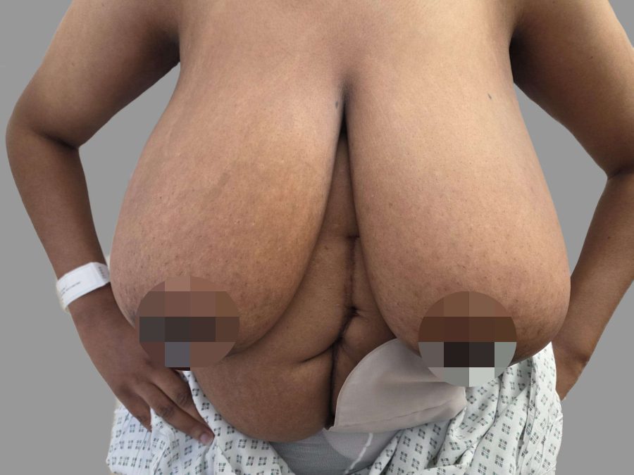 Breast Reduction - After