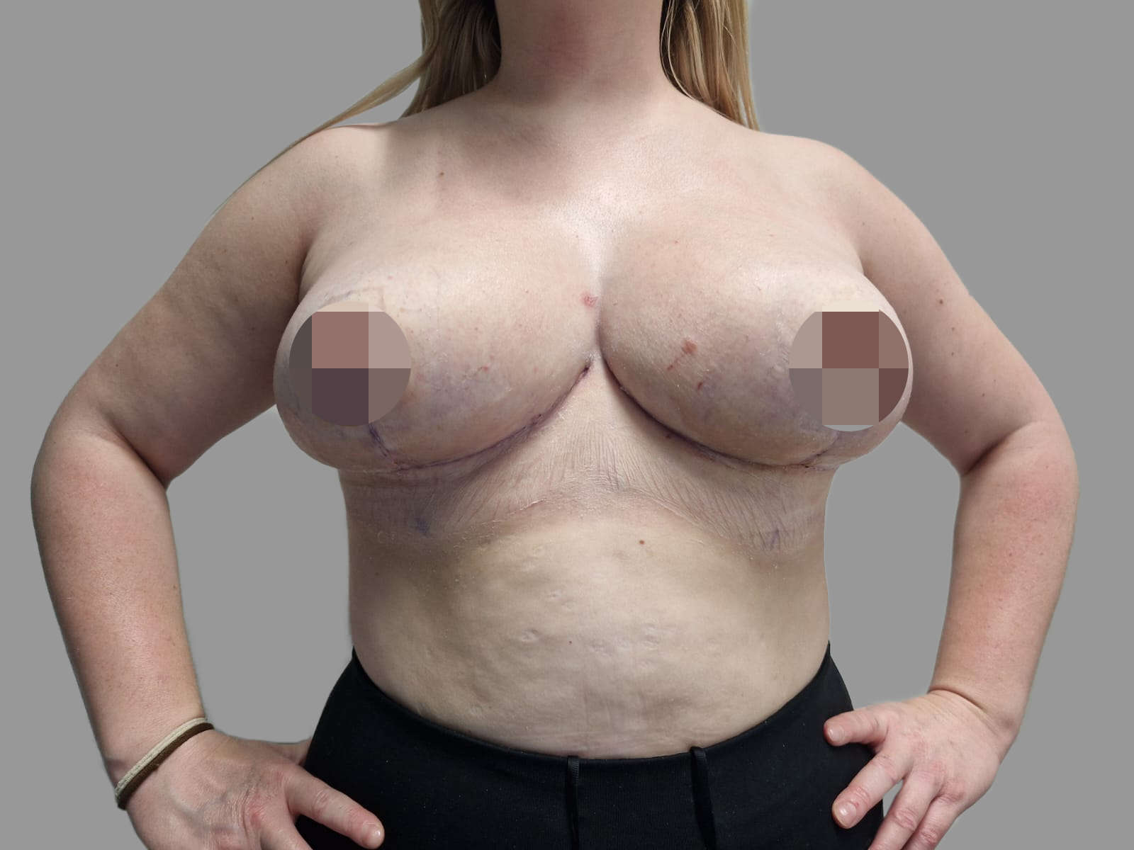 Breast Reduction - After