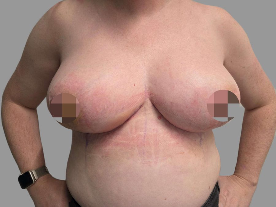 Breast Reduction - After